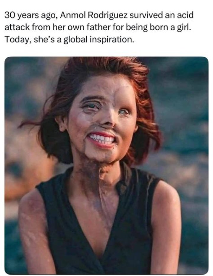 Inspirational Story Of A Acid Attack Survivor Anmol Rodriguez! A Girl Who Became The Victim Of Her Own Father When She Was A Child