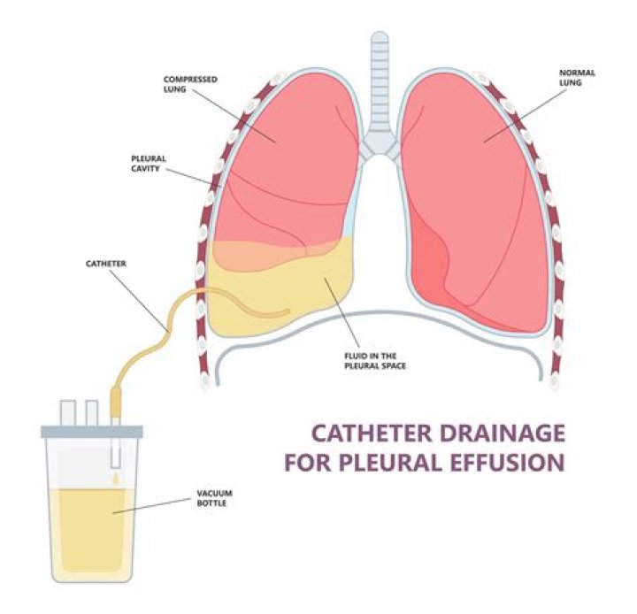 What is the CPT code for pleural effusion drainage?