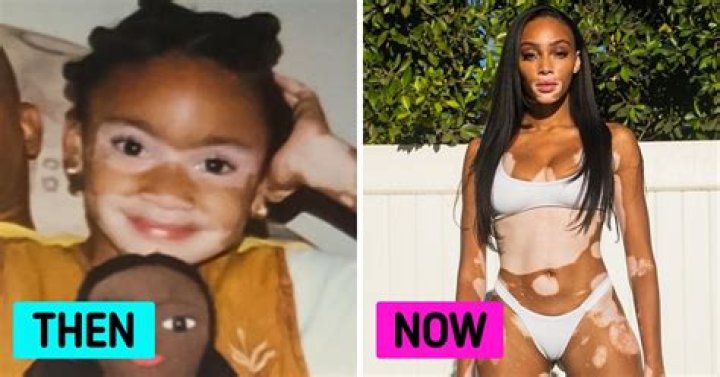 Winnie Harlow-the 1st model with skin condition-vitiligo-to walk the ramp for famous brands! Her childhood and confidence!